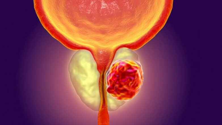 Η αξία και τα όρια του προληπτικού ελέγχου για τον καρκίνο του προστάτη