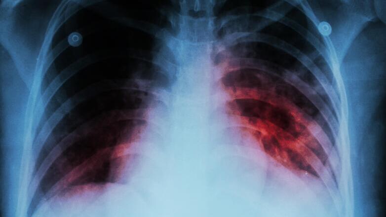 Φυματίωση: H φονικότερη μολυσματική νόσος παγκοσμίως, με 1,23 εκατ. θανάτους