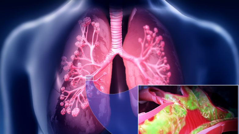 Χρόνια Αποφρακτική Πνευμονοπάθεια, μια συχνή και χρόνια ασθένεια