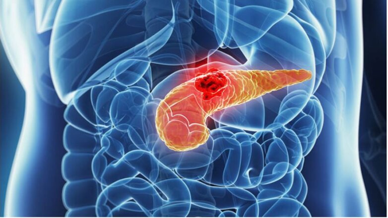 Καρκίνος του παγκρέατος: Τα ύπουλα συμπτώματα