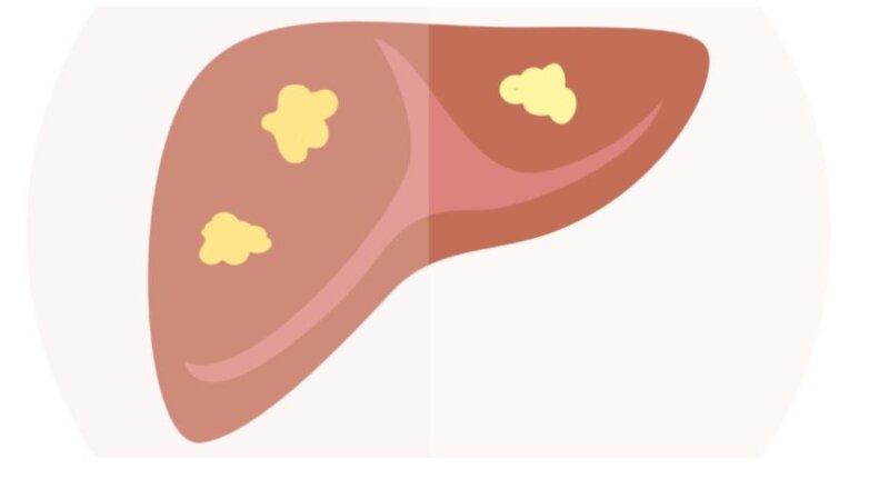 Δωρεάν μη επεμβατικός έλεγχος ήπατος στον Πειραιά