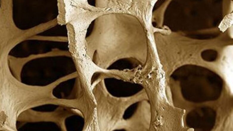 Οστεοπόρωση: Πώς σχετίζεται με το αδυνάτισμα;