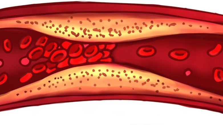 Λιποπρωτεΐνη (α): O γενετικός παράγοντας καρδιαγγειακού κινδύνου που δεν πρέπει να αγνοούμε